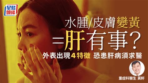 肝不好|出現9大症狀，代表肝病上身？江坤俊醫師一次說清楚